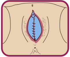 Type 3 FGM/C
